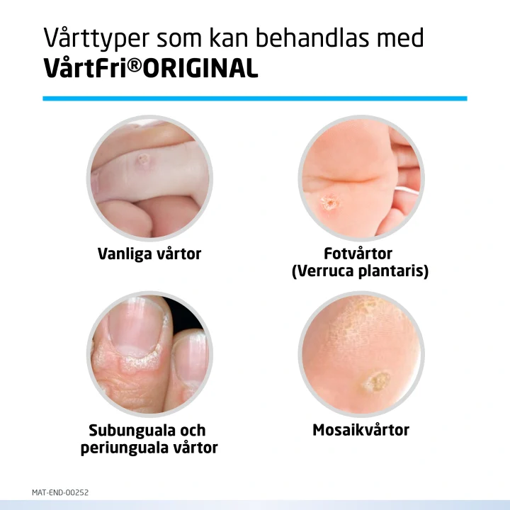 VårtFri Original Vårtmedel 5 ml Vårtfri